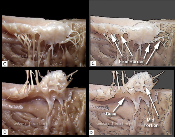 Tricuspid Valve 2